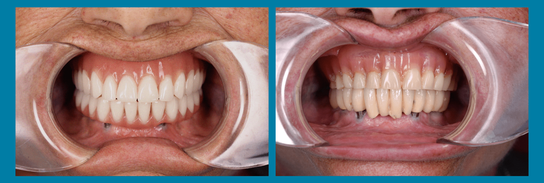 Ejemplo de rehabilitación dental. Imagen 1.
