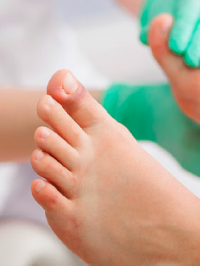 El tratamiento del pie diabético en el Centro Médico Meisa Centro